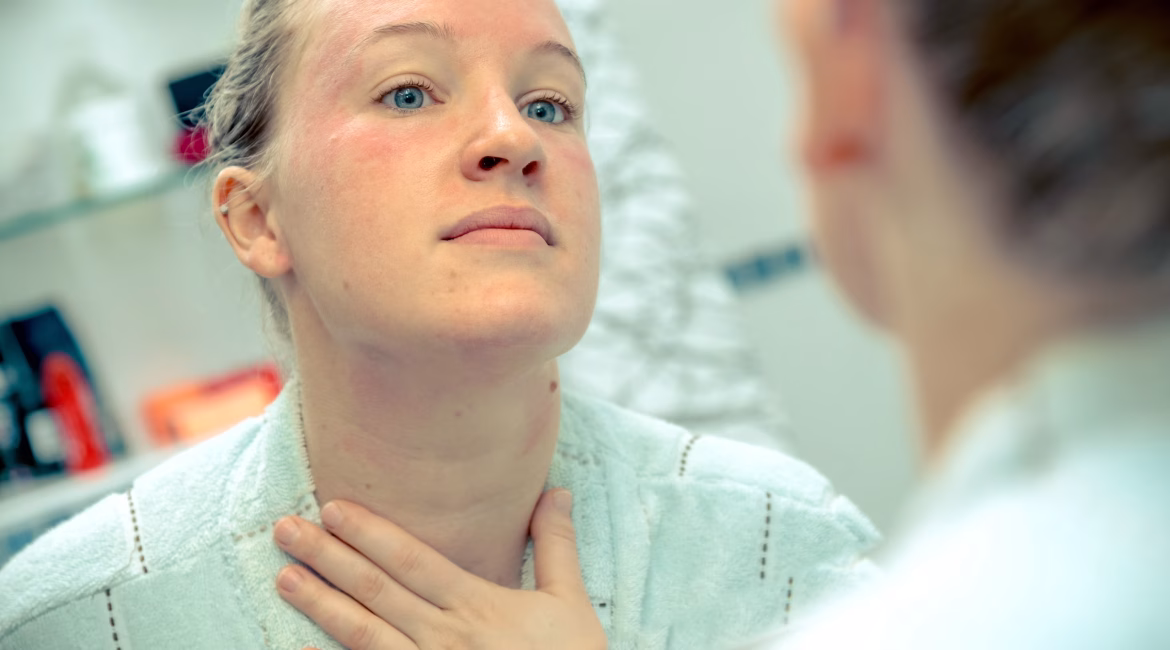 Cannabis Cream Eczema